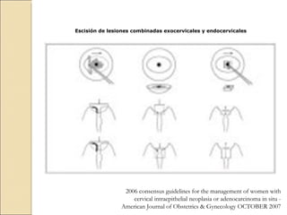 Escisión de lesiones combinadas exocervicales y endocervicales 2006 consensus guidelines for the management of women with cervical intraepithelial neoplasia or adenocarcinoma in situ -  American Journal of Obstetrics & Gynecology OCTOBER 2007 
