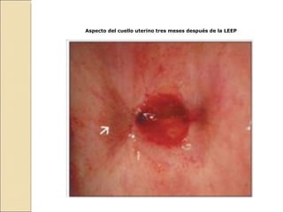Aspecto del cuello uterino tres meses después de la LEEP 