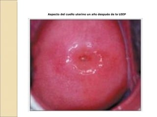 Aspecto del cuello uterino un año después de la LEEP 