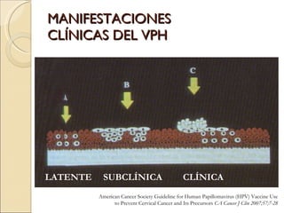 MANIFESTACIONES CLÍNICAS DEL VPH LATENTE SUBCLÍNICA CLÍNICA American Cancer Society Guideline for Human Papillomavirus (HPV) Vaccine Use to Prevent Cervical Cancer and Its Precursors  CA Cancer J Clin 2007;57;7-28 
