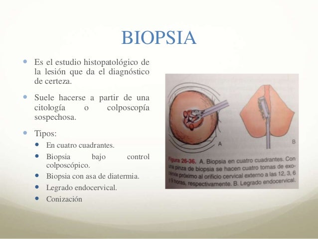 Neoplasia Intraepitelial Cervical