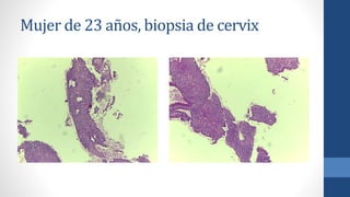 Mujer de 23 años, biopsia de cervix
 