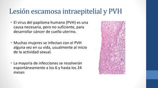 Lesión escamosa intraepitelial y PVH
• El virus del papiloma humano (PVH) es una
causa necesaria, pero no suficiente, para
desarrollar cáncer de cuello uterino.
• Muchas mujeres se infectan con el PVH
alguna vez en su vida, usualmente al inicio
de la actividad sexual.
• La mayoría de infecciones se resolverán
espontáneamente a los 6 y hasta los 24
meses
 