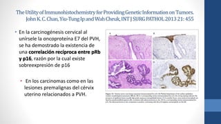 TheUtilityofImmunohistochemistryforProvidingGeneticInformationonTumors.
JohnK.C.Chan,Yiu-TungIpandWahCheuk,INTJSURGPATHOL201321:455
• En la carcinogénesis cervical al
unírsele la oncoproteína E7 del PVH,
se ha demostrado la existencia de
una correlación recíproca entre pRb
y p16, razón por la cual existe
sobreexpresión de p16
• En los carcinomas como en las
lesiones premalignas del cérvix
uterino relacionados a PVH.
 
