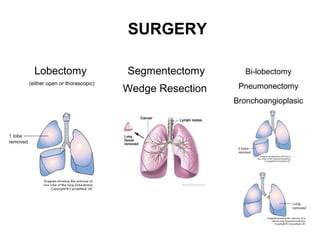Open Segmentectomy Further Supporting Evidence to Q4 (Part 2) - Dr MJ Devlin | PPT