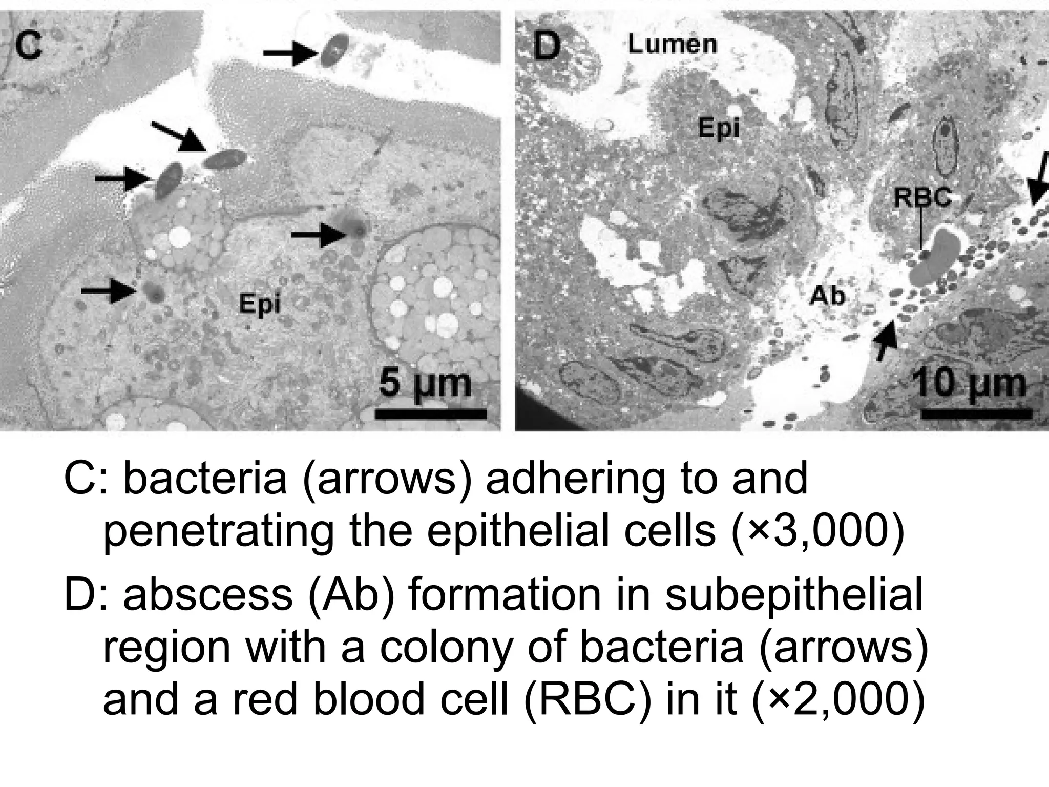 C: bacteria (arrows) adhering to and
penetrating the epithelial cells (×3,000)
D: abscess (Ab) formation in subepithelial
region with a colony of bacteria (arrows)
and a red blood cell (RBC) in it (×2,000)
 