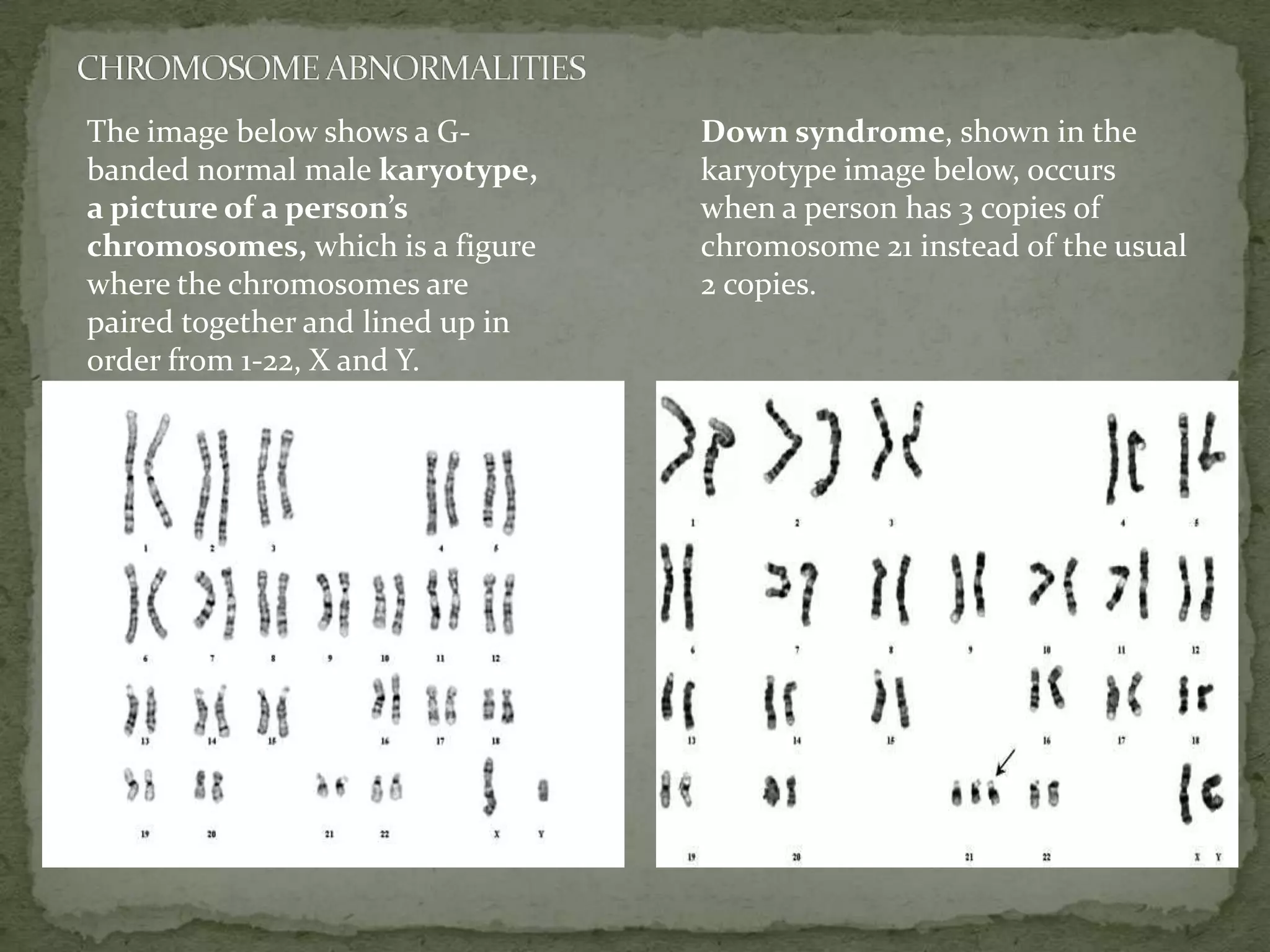 CHROMOSOME ABNORMALITITESChromosome abnormalities are errors on any of the body's 23 pairs of chromosomes, such as broken or missing pieces or  too many pieces or copies.  An error (or mutation) in a person's genes. Genes are carried on chromosomes, structures within the cell that carry information about all of a person's inherited traits. A person's genes may be damaged prior to, or during, conception and abnormal genes may be passed down through a family. Each person should have 46 chromosomes, arranged into 23 pairs. One pair of chromosomes, the sex chromosomes, are labeled XX for female and XY for male. The restof the chromosome pairs are numbered 1-22.  This normal set of 23 pairs of chromosomes is called the diploid number of chromosomes.  An individual pair of chromosomes is called a disomy.   In the normal situation one chromosome from each pair is inherited from the mother and the other from the father.  However, abnormalities can occur in which a whole chromosome or a portion of a chromosome can be added or deleted.  This occurrence results in addition or subtraction of genes, which cause can cause significant problems with growth and development.. 