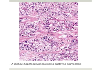 A scirrhous hepatocellular carcinoma displaying desmoplasia
 
