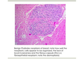 Benign Phyllodes neoplasm of breast: note how well the
neoplastic cells appear to be organized, the lack of
local invasiveness and the fibrous capsule (this is a
fibroepithelial neoplasm; note the desmoplasia)
 