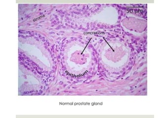 Normal prostate gland
 