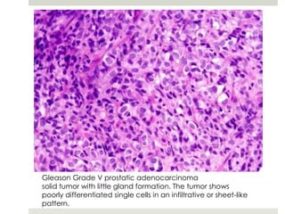 Gleason Grade V prostatic adenocarcinoma
solid tumor with little gland formation. The tumor shows
poorly differentiated single cells in an infiltrative or sheet-like
pattern.
 