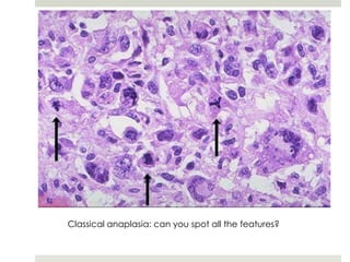 Classical anaplasia: can you spot all the features?
 