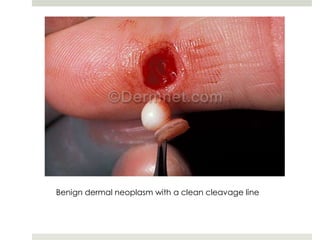 Benign dermal neoplasm with a clean cleavage line
 