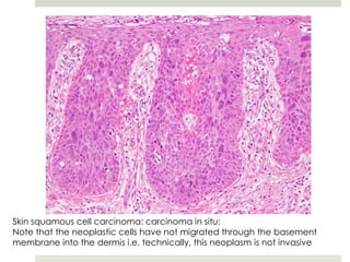 Skin squamous cell carcinoma: carcinoma in situ:
Note that the neoplastic cells have not migrated through the basement
membrane into the dermis i.e. technically, this neoplasm is not invasive
 
