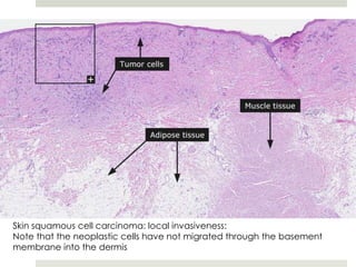 Skin squamous cell carcinoma: local invasiveness:
Note that the neoplastic cells have not migrated through the basement
membrane into the dermis
 