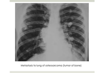 Metastasis to lung of osteosarcoma (tumor of bone)
 