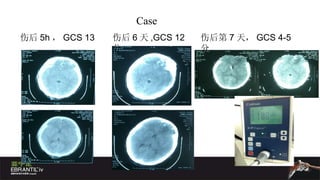 伤后 5h ， GCS 13 伤后 6 天 ,GCS 12 分 伤后第 7 天， GCS 4-5 分 Case  