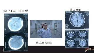 伤后 14 天， GCS 12 分 伤后 21 天出院 随访 MRI 