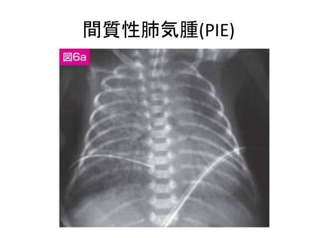 空気漏出症候群と胎便吸引症候群