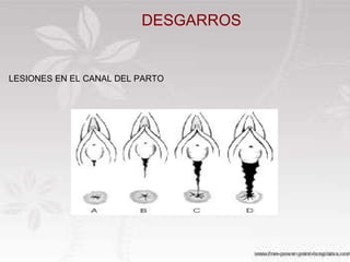 DESGARROS LESIONES EN EL CANAL DEL PARTO LESIONES EN EL CANAL DEL PARTO DESGARROS 