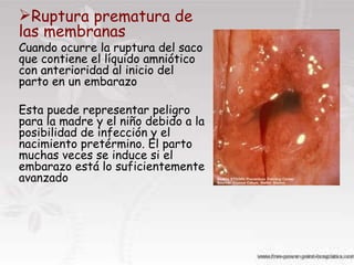 Ruptura prematura de las membranas   Cuando ocurre la ruptura del saco que contiene el líquido amniótico con anterioridad al inicio del parto en un embarazo  Esta puede representar peligro para la madre y el niño debido a la posibilidad de infección y el nacimiento pretérmino. El parto muchas veces se induce si el embarazo está lo suficientemente avanzado 