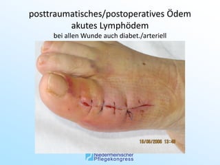 posttraumatisches/postoperatives Ödem
         akutes Lymphödem
     bei allen Wunde auch diabet./arteriell
 