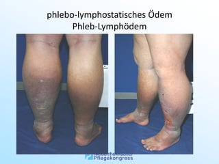 phlebo-lymphostatisches Ödem
      Phleb-Lymphödem
 