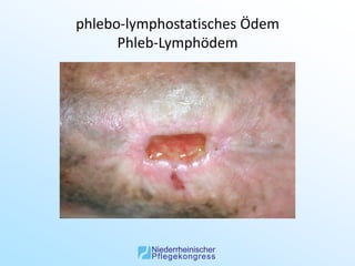 phlebo-lymphostatisches Ödem
      Phleb-Lymphödem
 