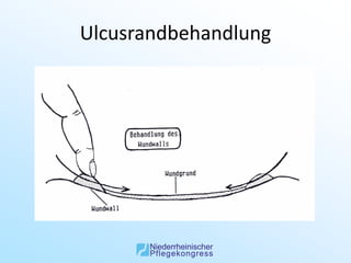 Ulcusrandbehandlung
 