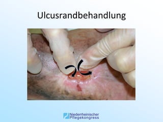 Ulcusrandbehandlung
 
