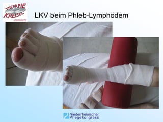 LKV beim Phleb-Lymphödem
 