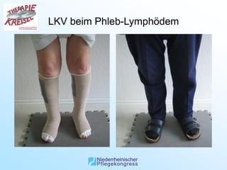 LKV beim Phleb-Lymphödem
 
