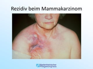 Rezidiv beim Mammakarzinom
 