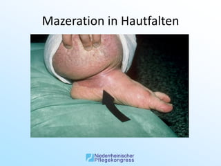 Mazeration in Hautfalten
 