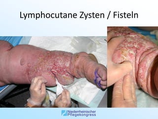 Lymphocutane Zysten / Fisteln
 