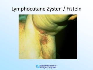 Lymphocutane Zysten / Fisteln
 