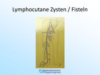 Lymphocutane Zysten / Fisteln
 