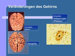 Veränderungen des Gehirns

                       Amyloid-
                       Ablagerungen
                       (Plaques)

        normales
        Gehirn




          Atrophie
 