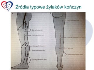 nietypowe-ylaki-ko-czyn-dolnych-ppt