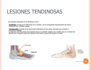LESIONES TENDINOSAS  Son lesiones producidas en los tendones. Como: Tendinitis:  se trata de la inflamación de un tendón, con el consiguiente engrosamiento del mismo ocasionado por múltiples causas. Tenosinovitis:  Consiste en la reactivación inflamatoria de las vainas sinoviales que recubren o envuelven el tendón. Las lesiones más frecuentes son tendinitis tanto en el tendón rotuliano de la rodilla como en el tendón de Aquiles que en algunos casos aún siendo el más fuerte y grueso del cuerpo se rompe. 