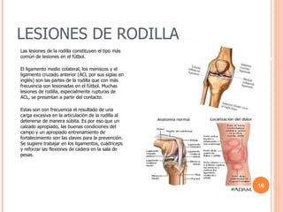 LESIONES DE RODILLA Las lesiones de la rodilla constituyen el tipo más común de lesiones en el fútbol.  El ligamento medio colateral, los meniscos y el ligamento cruzado anterior (ACL por sus siglas en inglés) son las partes de la rodilla que con más frecuencia son lesionadas en el fútbol. Muchas lesiones de rodilla, especialmente rupturas de ACL, se presentan a partir del contacto.  Estas son con frecuencia el resultado de una carga excesiva en la articulación de la rodilla al detenerse de manera súbita. Es por eso que un calzado apropiado, las buenas condiciones del campo y un apropiado entrenamiento de fortalecimiento son las claves para la prevención. Se sugiere trabajar en los ligamentos, cuádriceps y reforzar las flexiones de cadera en la sala de pesas.  