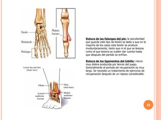 Rotura de las falanges del pie:  la peculiaridad que guarda este tipo de lesión se debe a que en la mayoría de los casos esta lesión se produce involuntariamente, tanto que ni el que se lesiona como el que lesiona se suelen dar cuenta hasta que después del partido se enfrían. Rotura de los ligamentos del tobillo:  rotura muy dolora producida por lances del juego. Generalmente el período de recuperación es muy largo. Se necesita un tratamiento de ejercicios de recuperación después de un reposo considerable. 