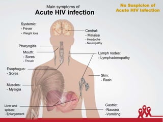 No Suspicion of
Acute HIV Infection
18
 