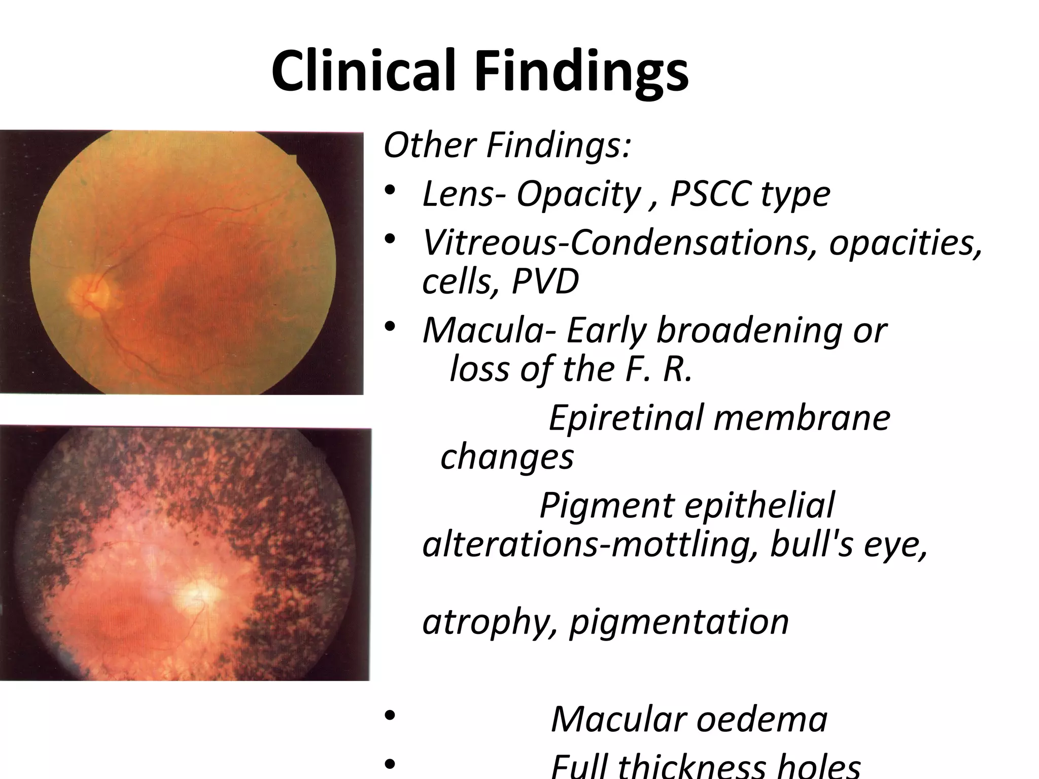 Clinical Findings
Other Findings:
• Lens- Opacity , PSCC type
• Vitreous-Condensations, opacities,
cells, PVD
• Macula- Early broadening or
loss of the F. R.
Epiretinal membrane
changes
Pigment epithelial
alterations-mottling, bull's eye,
atrophy, pigmentation
• Macular oedema
•
 