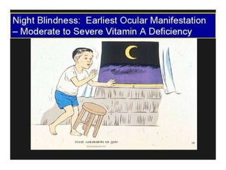 Night blindness (vitamin a)