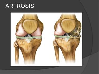 ARTROSIS
 