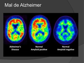 Mal de Alzheimer
 