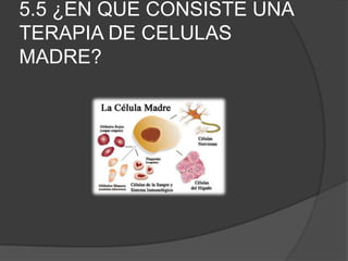 5.5 ¿EN QUE CONSISTE UNA
TERAPIA DE CELULAS
MADRE?
 