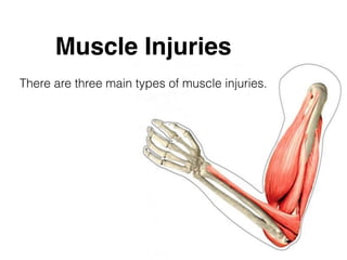 Muscle Injuries
There are three main types of muscle injuries.
 