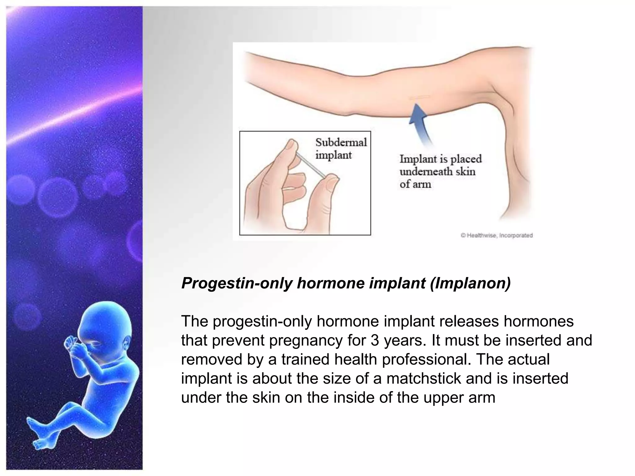 Progestin-only hormone implant (Implanon)
The progestin-only hormone implant releases hormones
that prevent pregnancy for 3 years. It must be inserted and
removed by a trained health professional. The actual
implant is about the size of a matchstick and is inserted
under the skin on the inside of the upper arm
 